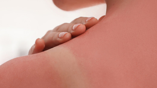 Sonnenbrand richtig behandeln: Die besten Tipps für schnelle Linderung und effektive Pflege