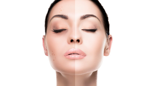 Pigmentflecken gezielt reduzieren und vorbeugen