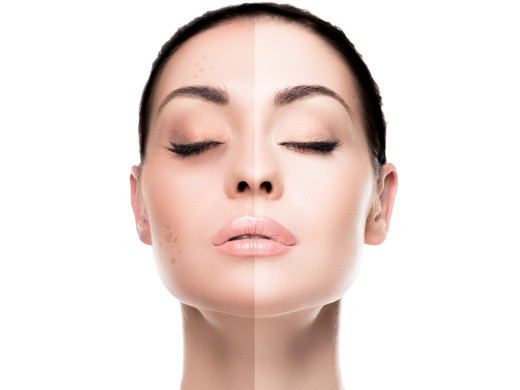 Pigmentflecken gezielt reduzieren und vorbeugen